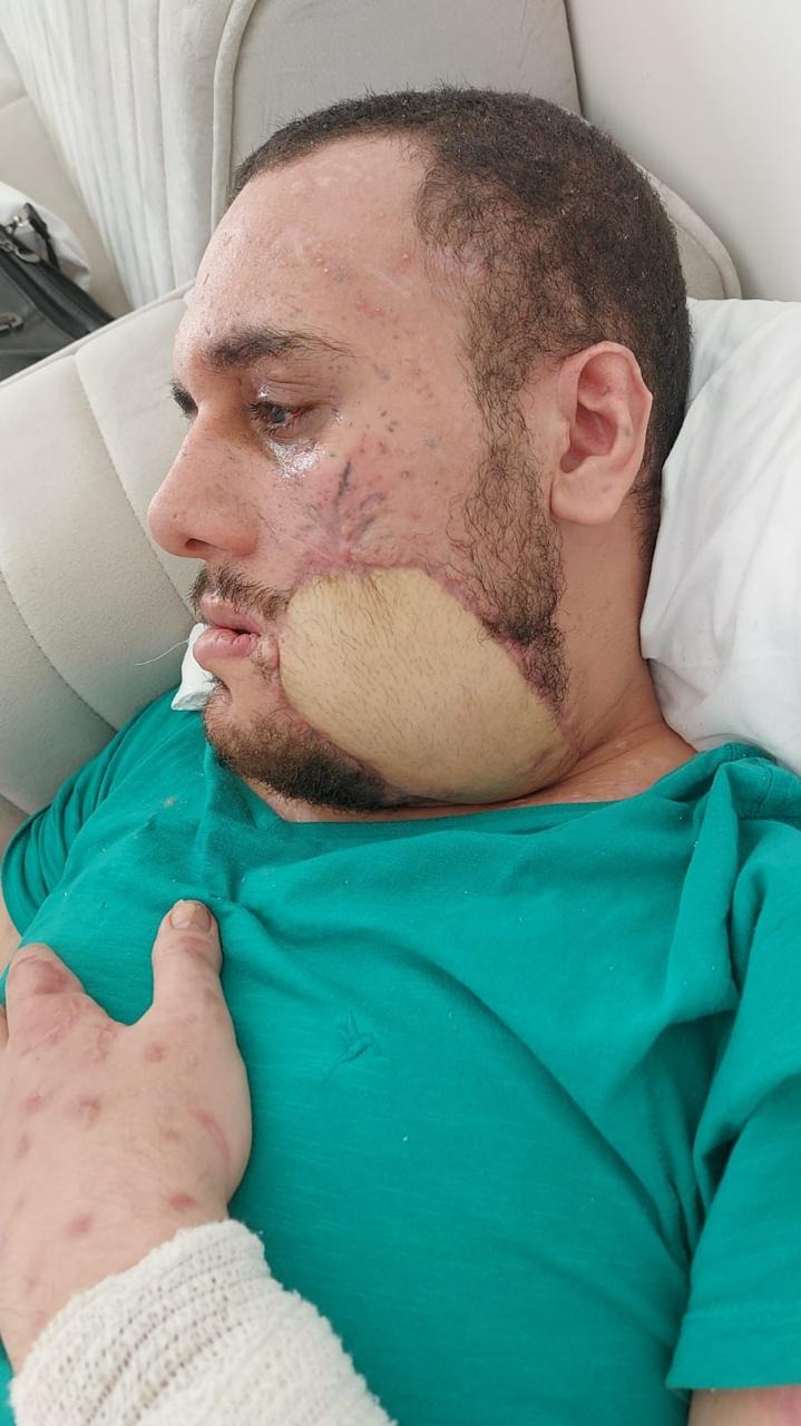 Urgent Facial Reconstruction Surgery for Abood